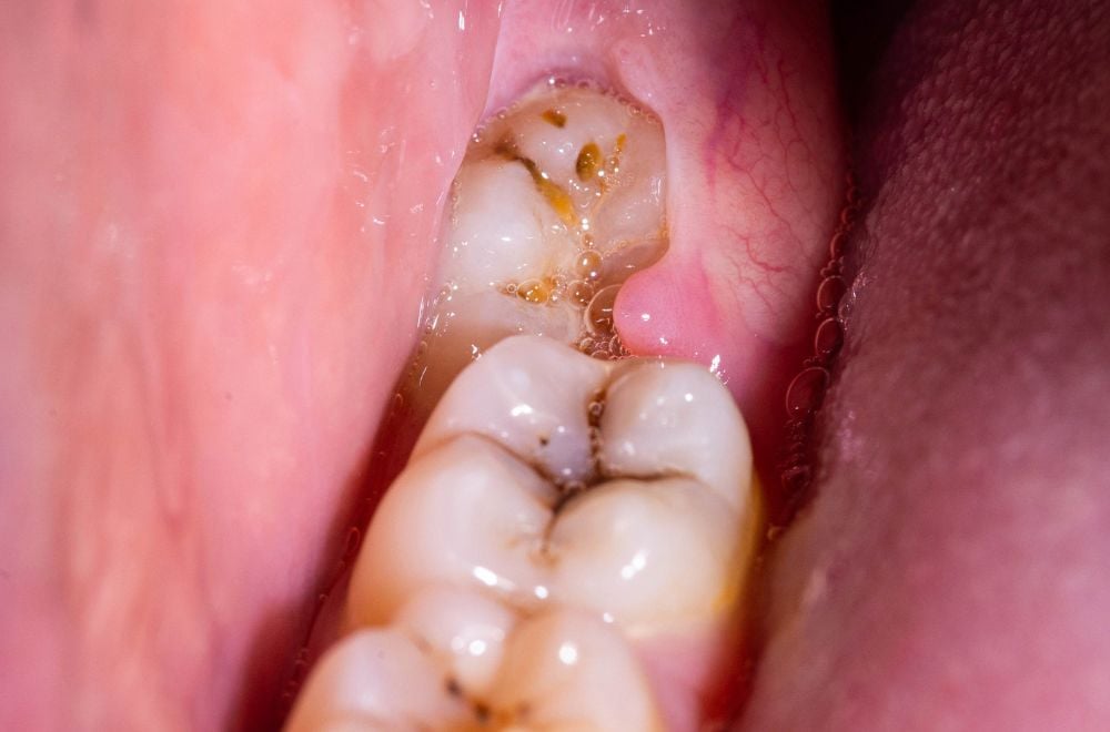 pericoronitis-infection